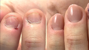 Short Bitten Nails & Skin Transformation