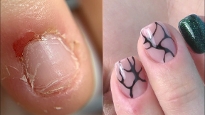 Amazing Transformation of Bitten Nails after 3 Manicures