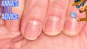 Peeling Nails Common Causes [ANNA'S NAIL ADVICE]