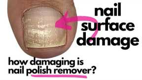 How Damaging Is Nail Polish Remover/Acetone?!  [Surprise, Surprise!]