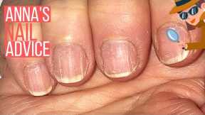 How To Care For Ridgy Nails  [ANNA'S NAIL ADVICE] ?️‍♀️