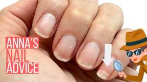 WHITE PATCHES ON NAILS? ANNA HELP! [ANNA'S NAIL ADVICE]