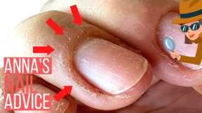 THINKING ABOUT GEL POLISH? YOU NEED TO KNOW WHY THIS HAPPENS [ALLERGIC REACTIONS & OVEREXPOSURE]