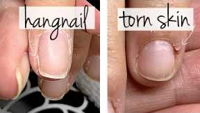Hangnail or Torn Skin? [What's the Difference?]