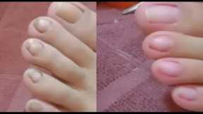 INGROWN REMOVAL PEDICURE CLEANING PAOLA /SATISFYING CLIENT72 @Che che Legario