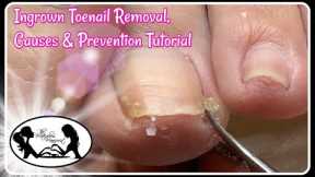 👣 Ingrown Toenail Removal Causes and Prevention Pedicure Tutorial 👣