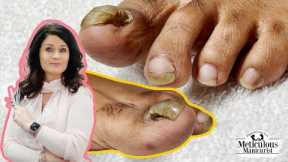 👣Tutorial on How to Care & Treat a Detached Big Toenail with a Pedicure👣