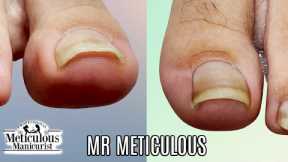 👣Big Toes Only - IMPACTED TOENAIL Gunk Removal on Mr. Meticulous👣