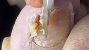 Professional pedicure video: pulling out huge ingrown nails【Crazy pedicure room】