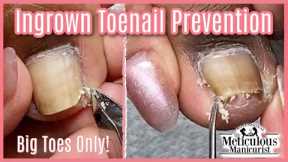 👣Pedicure How To on Ingrown Toenail Pain, Cleaning, and Prevention 👣