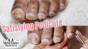 👣Pedicure Tips for Excessive Impacted Cuticle and Yellow Toenails👣