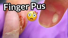 Infected Finger After Nail Salon 😱 WHY did it happen? | Paronychia