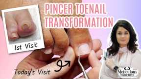 👣Pincer Ingrown Toenail Transformation How to Pedicure👣