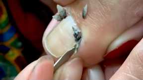 HOW TO CUT THICK TOENAILS  - Toenail Cleaning Satisfying #22
