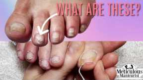 👣How to Fix White Patches on Toenails👣