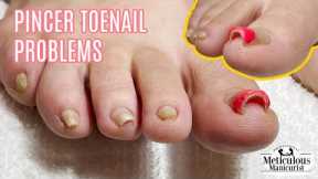 👣Pedicure Tutorial on Pincer Toenails that Cause Pain👣