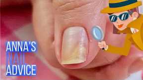 Why Does Nail Separate | Causes | Early Treatment of Onycholysis [Anna's Nail Advice]