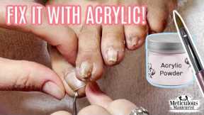 👣 How to use Acrylic to Fix a Pincer Toenail Tutorial👣