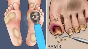 ASMR Climber's plantar calluses and rot toenails care animation