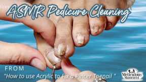 👣ASMR Pedicure Cleaning💆‍♀️How to use Acrylic to Fix a Pincer Toenail Tutorial👣