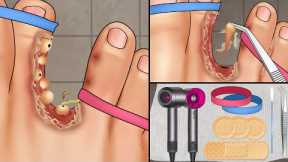 ASMR Treatment athlete's foot and warts between toes at home | Foot care animation