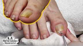 👣How to get rid of Yellow Toenails👣