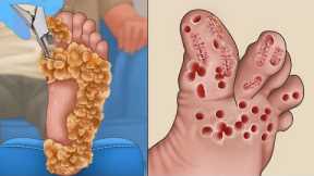 ASMR Pedicure contagious viral warts all over the feet | Foot care animation