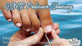 👣ASMR Pedicure Cleaning 💆‍♀️ Pincer Ingrown Toenail Transformation👣