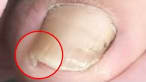 Rescuing a Trapped Ingrown Toenail【Crazy pedicure room】