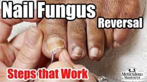 A Toenail Fungus Cure! What did she do? 👣