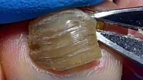 Pull out onychomycosis, the toenails have become completely empty【Pedicure Master Lin Jun】