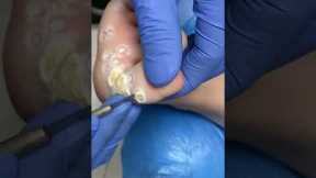 Professional pedicure: treating warts with care