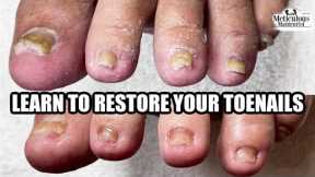 👣Learn to Restore Your Toenails👣