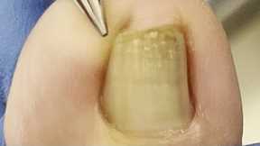 Amazing pedicure video! Extremely curly ingrown nails, digging out very large pieces of nails