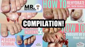 👣Pedicure Compilation on Impacted, Ingrown, and Pincer Toenails (Part 1)👣