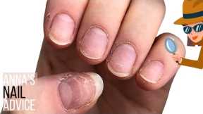 Nail damage, HEMA fears, allergic reactions & what nail tech doesn't tell you. [Anna's Nail Advice]