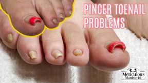 👣Pedicure Tutorial on Big Pincer Toenails that Cause Pain👣