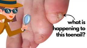Whats wrong with this baby toenail? [Anna's Nail Advice] 🕵️