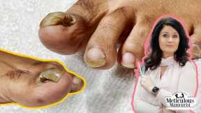 👣Tutorial on How to Care & Treat a Detached Toenail with a Pedicure👣
