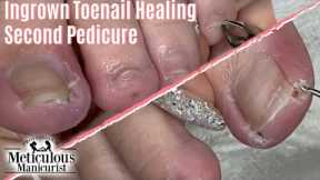 👣 How To Heal Ingrown Toenail at Home Salon Pedicure Second Visit 👣