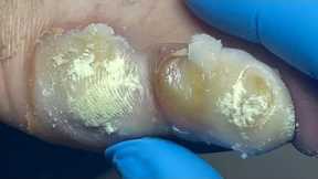 Bacterial infection of the toenails, removal of large amounts of dead skin【Pedicure Master Lin Jun】