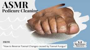 👣ASMR Pedicure Cleaning💆‍♀️How to Reverse Toenail Changes caused by Toenail Fungus👣