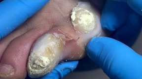 Remove dead toe skin and bad nails, nasty onychomycosis bacteria【Pedicure Master Lin Jun】