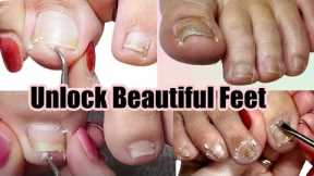 Reveal Radiant Feet: Pedicure Compilation for Impacted, Ingrown, + Pincer Toenails! (part 1)