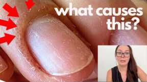 Swelling, pain, blisters after gel polish. Pro nail technician explains.