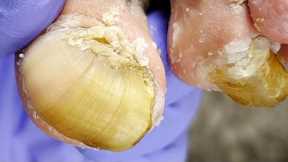 Woman's toenails curled like snail shells, professional pedicure【Xue Yidao】