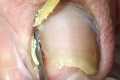 The amazing amount of dead skin under 
