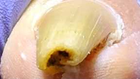 The ingrown toenail is rolled into a circle!Pedicure for a 63-year-old patient【Xue Yidao】