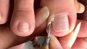 Clean the Skin and remove the corner of the nail#481