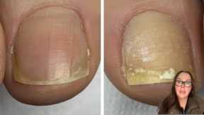 She wore nail polish only on 1 foot (and here is what happened)